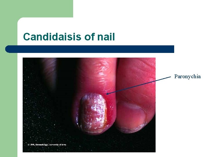 Candidaisis of nail Paronychia 