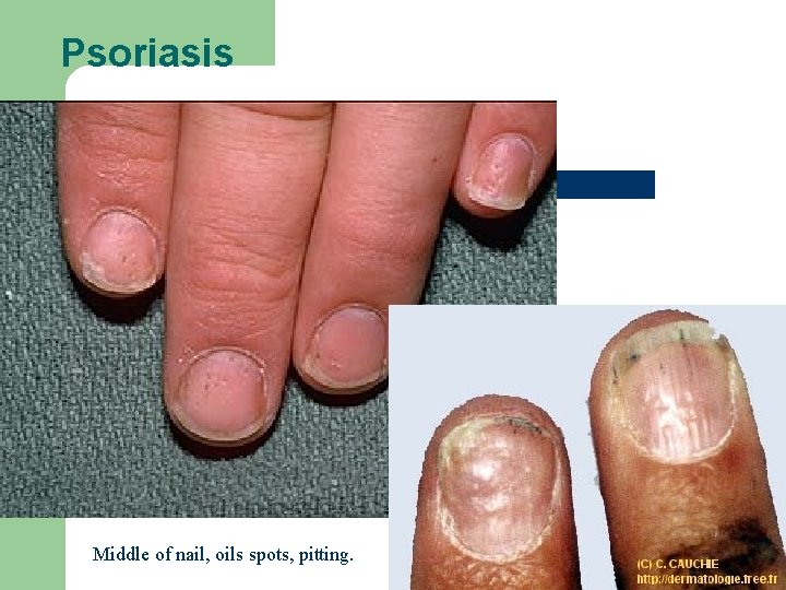 Psoriasis Middle of nail, oils spots, pitting. 