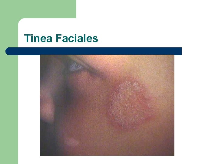 Tinea Faciales 