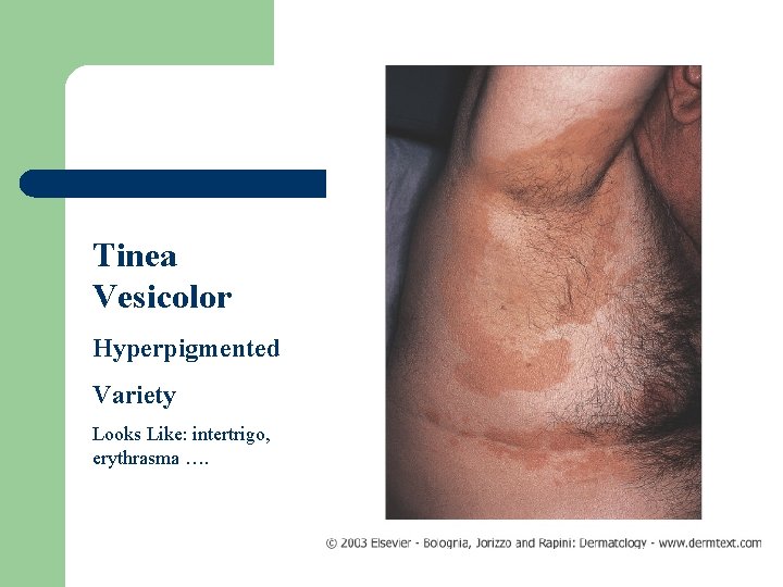 Tinea Vesicolor Hyperpigmented Variety Looks Like: intertrigo, erythrasma …. 