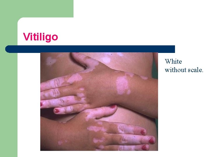 Vitiligo White without scale. 
