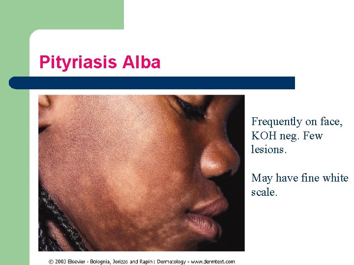 Pityriasis Alba Frequently on face, KOH neg. Few lesions. May have fine white scale.