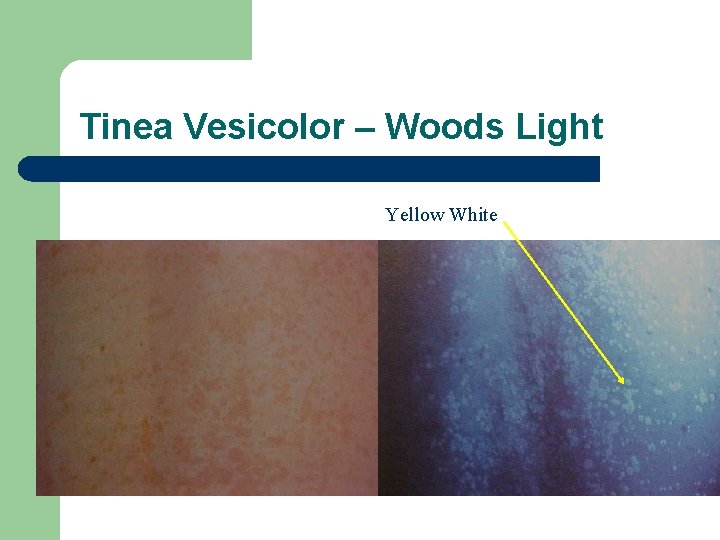 Tinea Vesicolor – Woods Light Yellow White 
