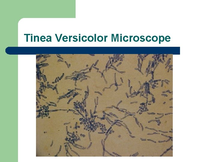 Tinea Versicolor Microscope 