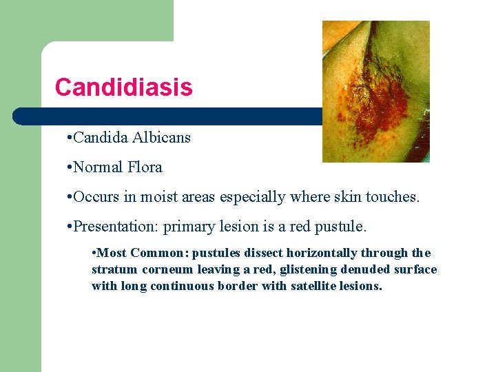 Candidiasis • Candida Albicans • Normal Flora • Occurs in moist areas especially where