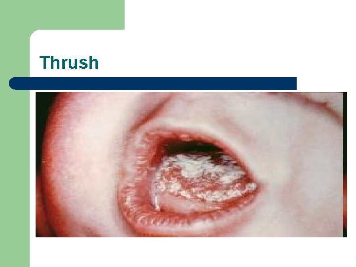 Thrush 