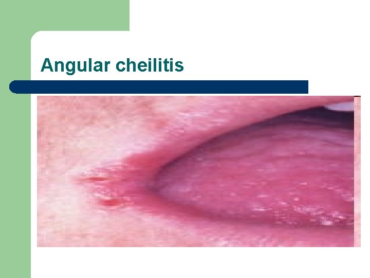 Angular cheilitis 