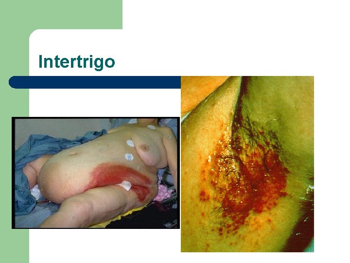 Intertrigo 
