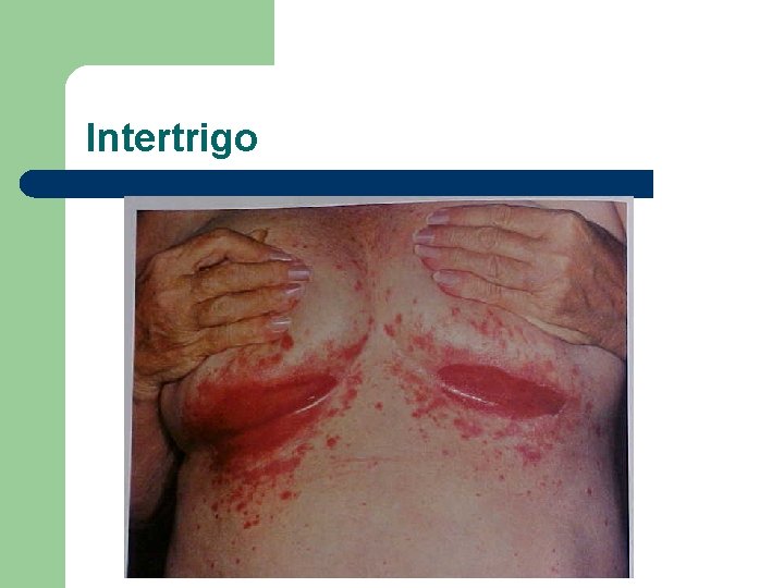 Intertrigo 