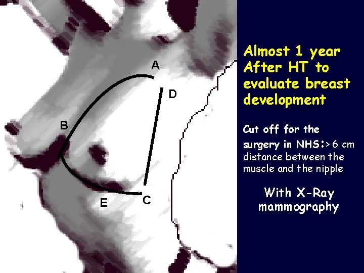 A D B Almost 1 year After HT to evaluate breast development Cut off