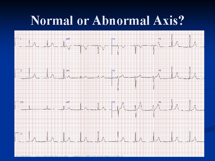 Normal or Abnormal Axis? 
