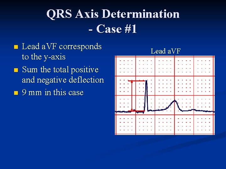 QRS Axis Determination - Case #1 n n n Lead a. VF corresponds to
