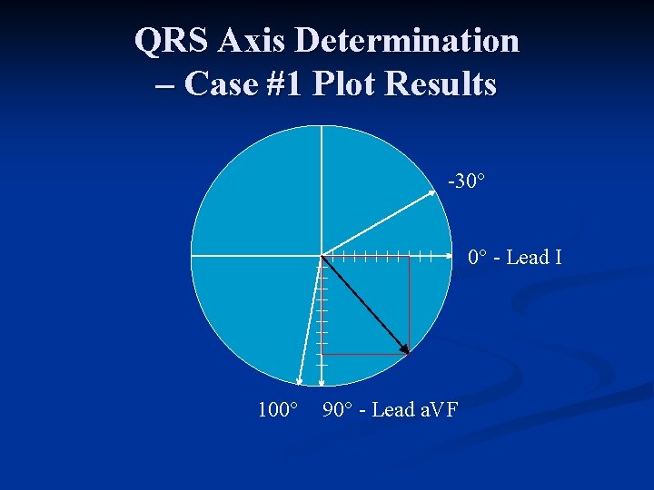 QRS Axis Determination – Case #1 Plot Results 30° 0° Lead I 100° 90°