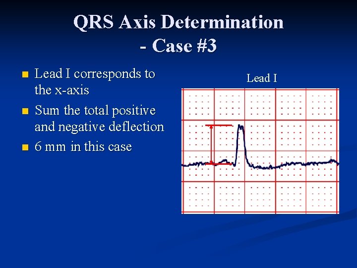 QRS Axis Determination - Case #3 n n n Lead I corresponds to the