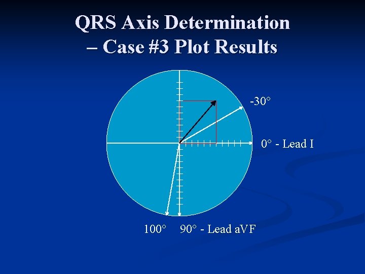 QRS Axis Determination – Case #3 Plot Results 30° 0° Lead I 100° 90°