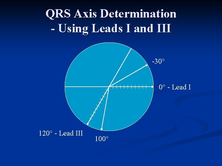 QRS Axis Determination - Using Leads I and III 30° 0° Lead I 120°