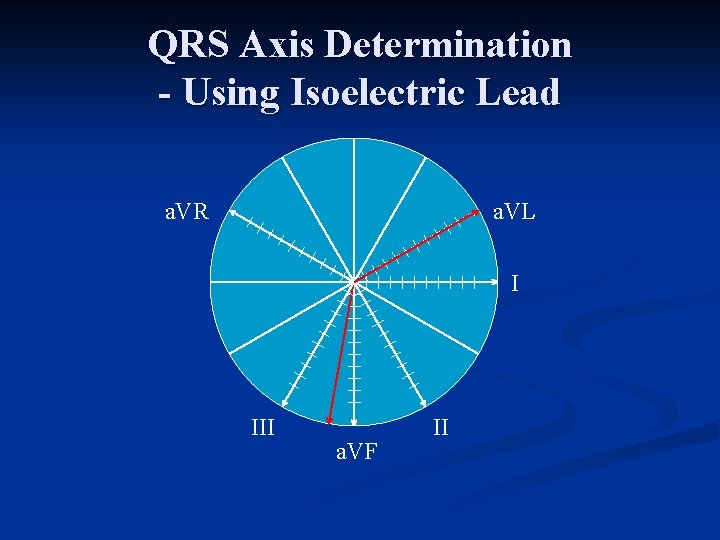 QRS Axis Determination - Using Isoelectric Lead a. VR a. VL I III a.