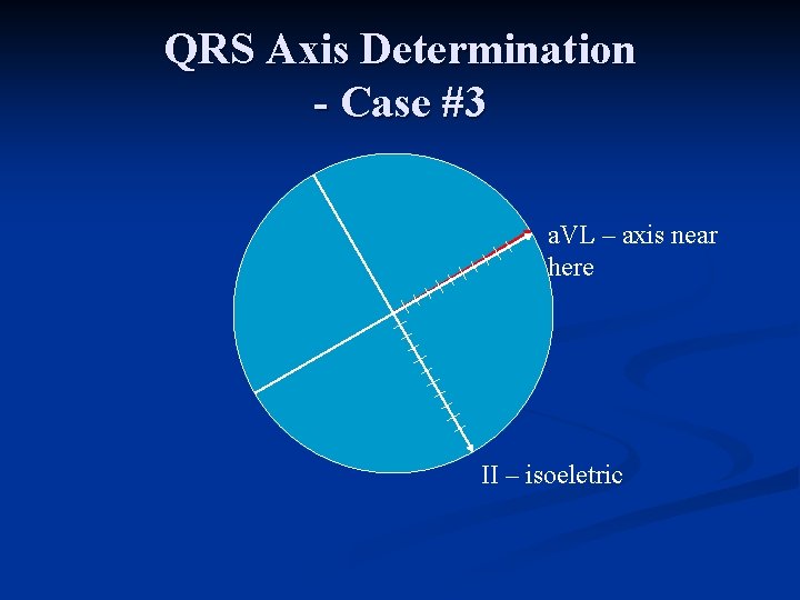 QRS Axis Determination - Case #3 a. VL – axis near here II –