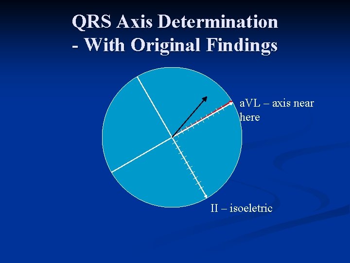 QRS Axis Determination - With Original Findings a. VL – axis near here II