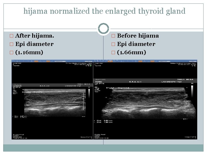 hijama normalized the enlarged thyroid gland � After hijama. � Before hijama � Epi
