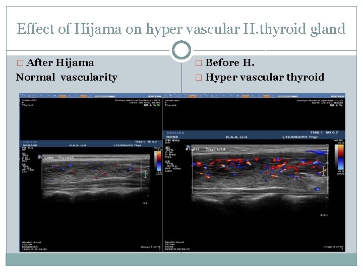 Effect of Hijama on hyper vascular H. thyroid gland � After Hijama � Before