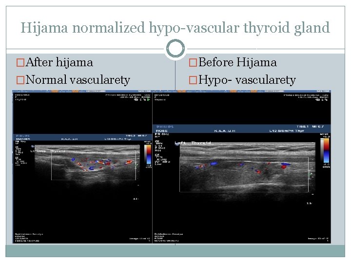 Hijama normalized hypo-vascular thyroid gland �After hijama �Before Hijama �Normal vascularety �Hypo- vascularety 