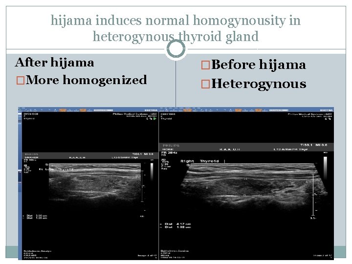 hijama induces normal homogynousity in heterogynous thyroid gland After hijama �More homogenized �Before hijama