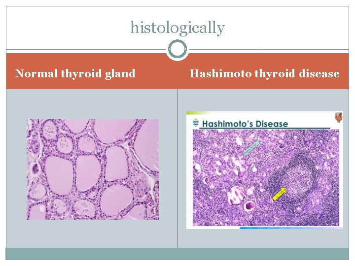 histologically Normal thyroid gland Hashimoto thyroid disease 