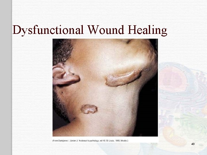 Dysfunctional Wound Healing 49 