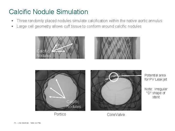 Calcific Nodule Simulation § Three randomly placed nodules simulate calcification within the native aortic