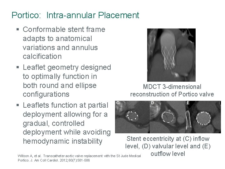 Portico: Intra-annular Placement § Conformable stent frame adapts to anatomical variations and annulus calcification