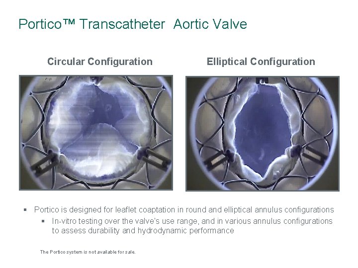 Portico™ Transcatheter Aortic Valve Circular Configuration Elliptical Configuration § Portico is designed for leaflet