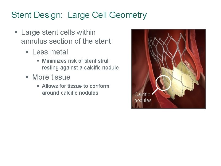 Stent Design: Large Cell Geometry § Large stent cells within annulus section of the