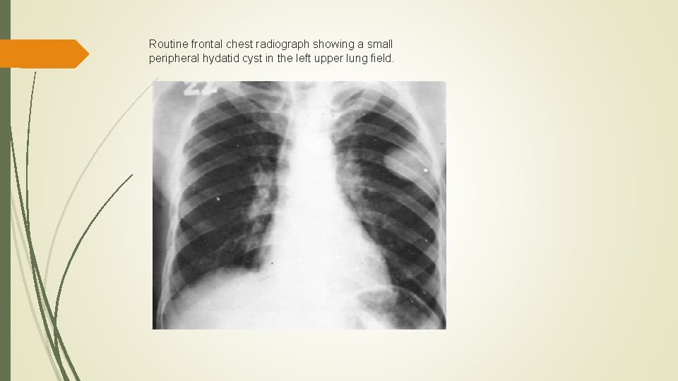 Routine frontal chest radiograph showing a small peripheral hydatid cyst in the left upper