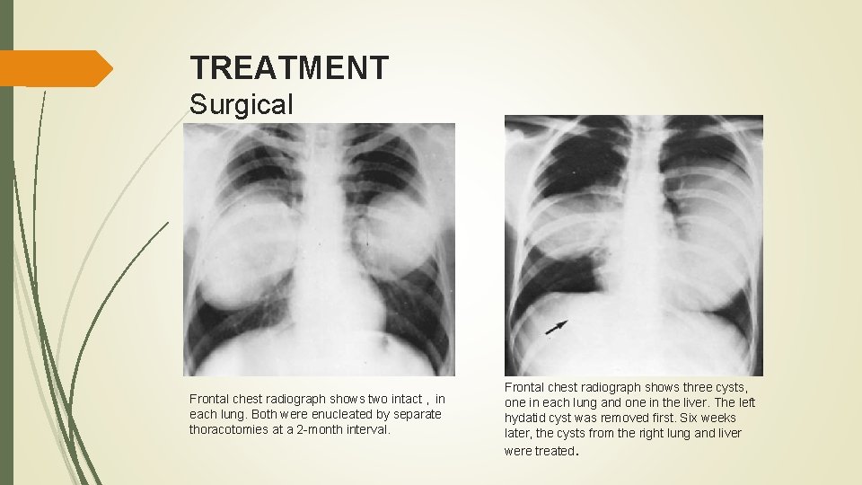 TREATMENT Surgical Frontal chest radiograph shows two intact , in each lung. Both were