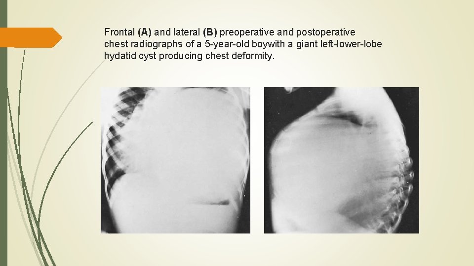 Frontal (A) and lateral (B) preoperative and postoperative chest radiographs of a 5 -year-old