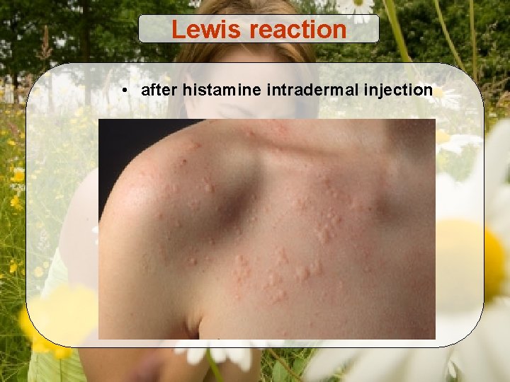 Lewis reaction • after histamine intradermal injection 