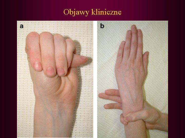 Objawy kliniczne 