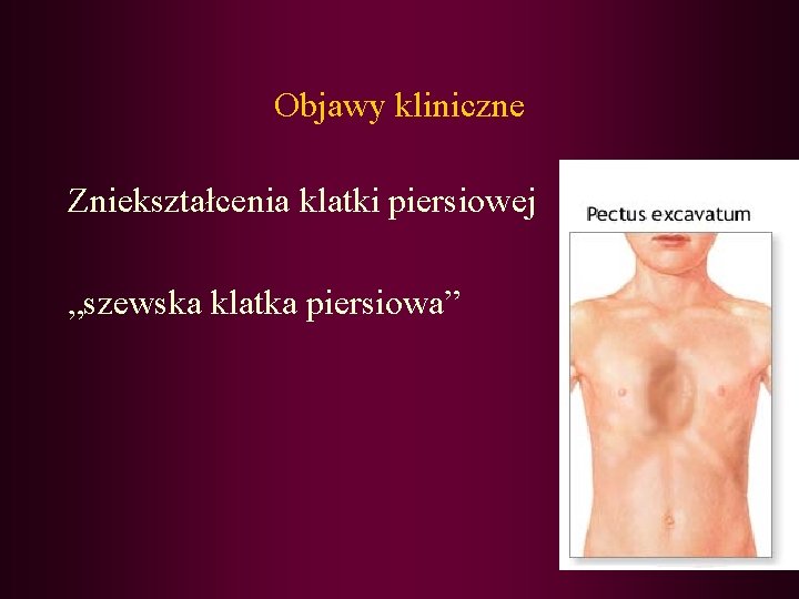 Objawy kliniczne Zniekształcenia klatki piersiowej „szewska klatka piersiowa” 