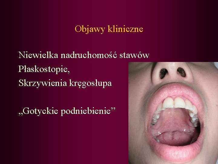 Objawy kliniczne Niewielka nadruchomość stawów Płaskostopie, Skrzywienia kręgosłupa „Gotyckie podniebienie” 