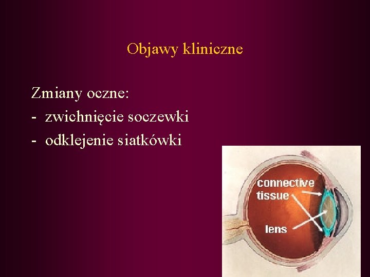 Objawy kliniczne Zmiany oczne: - zwichnięcie soczewki - odklejenie siatkówki 