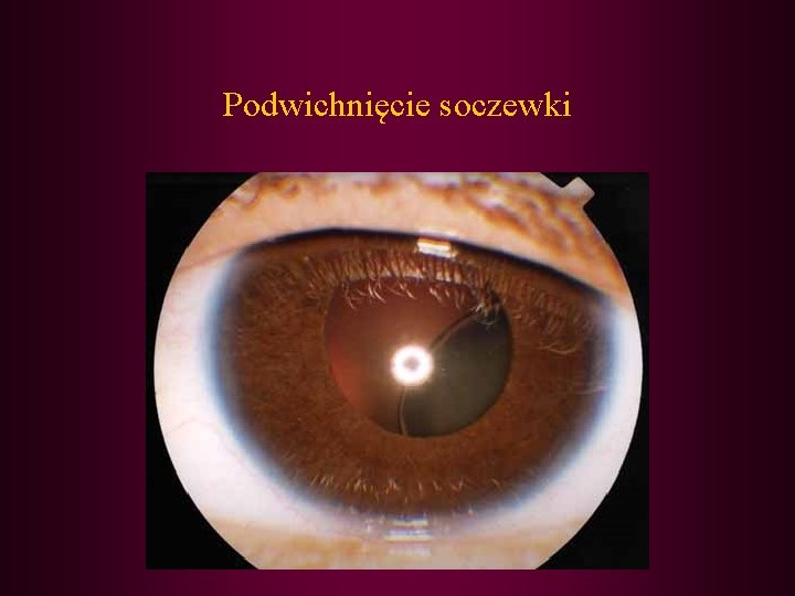 Podwichnięcie soczewki 