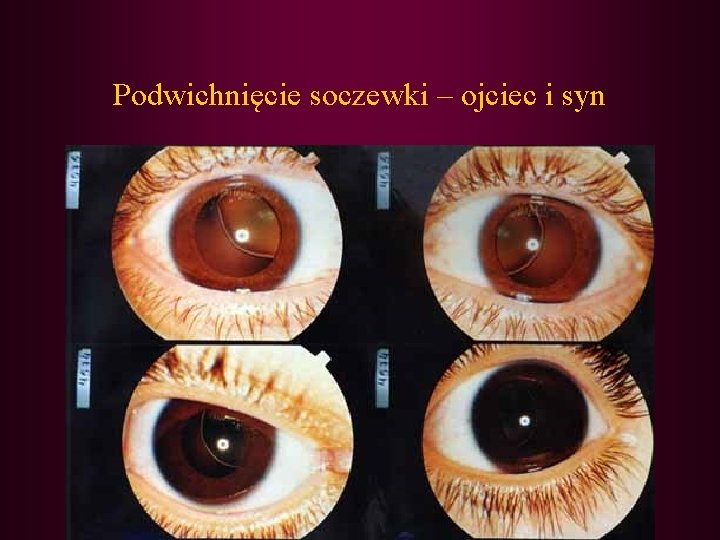 Podwichnięcie soczewki – ojciec i syn 