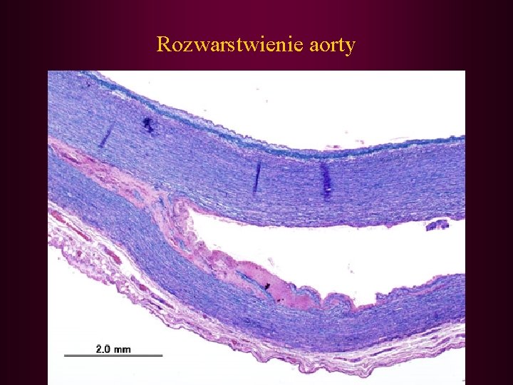 Rozwarstwienie aorty 