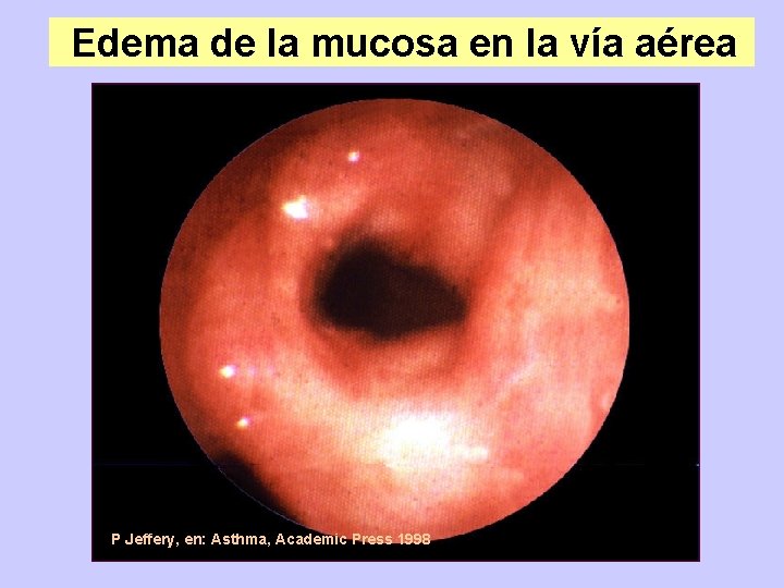 Edema de la mucosa en la vía aérea P Jeffery, en: Asthma, Academic Press