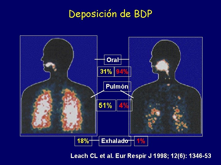 Deposición de BDP Oral 31% 94% Pulmón 51% 4% 18% Exhalado 1% Leach CL