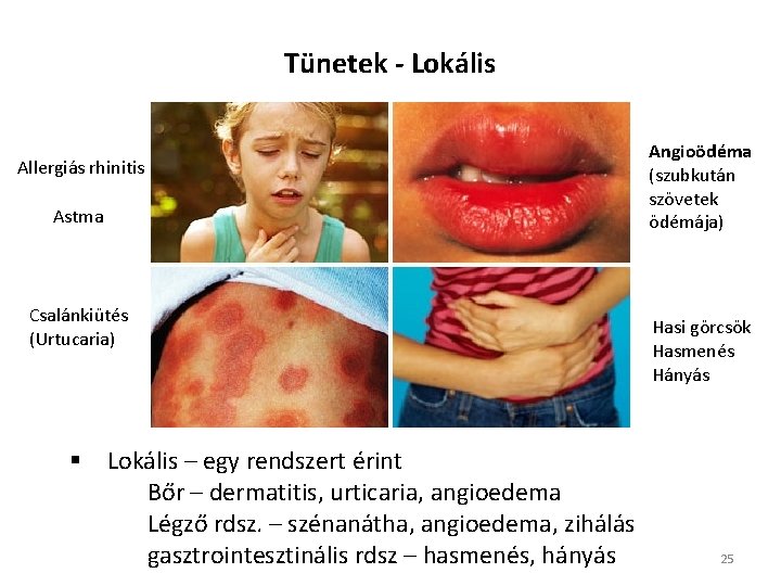 Tünetek - Lokális Allergiás rhinitis Astma Csalánkiütés (Urtucaria) § Lokális – egy rendszert érint