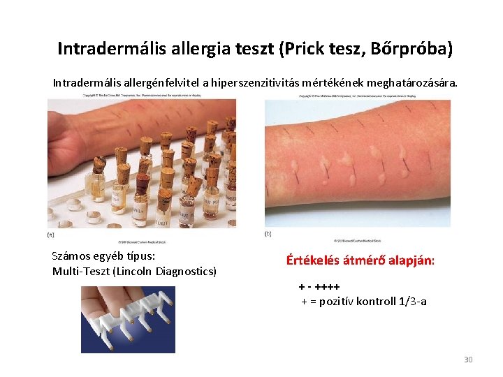 Intradermális allergia teszt (Prick tesz, Bőrpróba) Intradermális allergénfelvitel a hiperszenzitivitás mértékének meghatározására. Számos egyéb