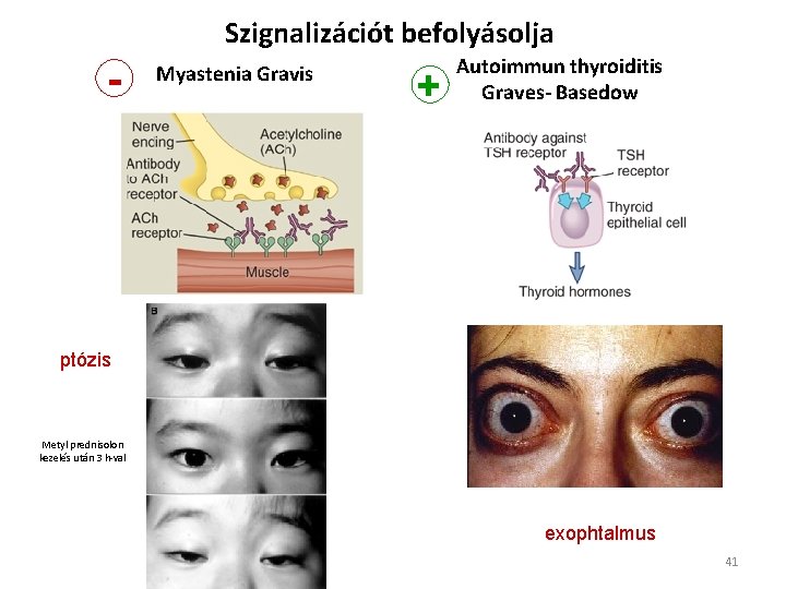 Szignalizációt befolyásolja - Myastenia Gravis + Autoimmun thyroiditis Graves- Basedow ptózis Metyl prednisolon kezelés