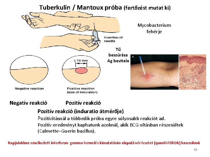 Tuberkulin / Mantoux próba (fertőzést mutat ki) Mycobacterium fehérje Tű beszúrása Ag bevitele Negatív